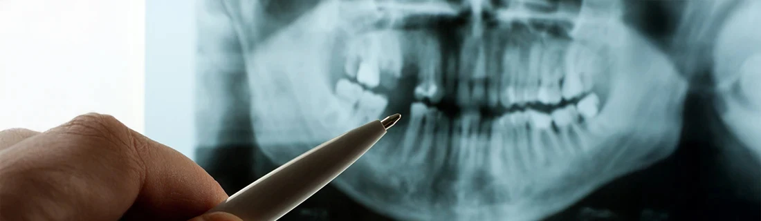 Dentist Cave Creek AZ All-In-4 Dentist Cave Creek AZ All-In-4