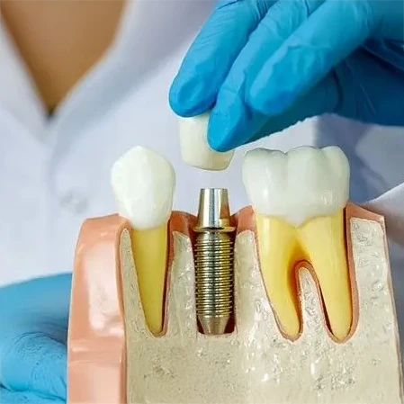 Dentist Cave Creek AZ Implants Service